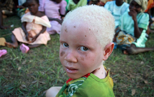 Адепты колдовских культов в Танзании расчленяют детей-альбиносов. ФОТО